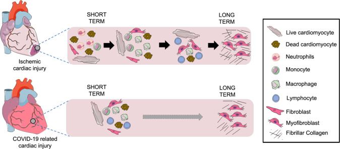 COVID-19 and long term cardiac injury. Source: Unudurthi, Luthra, Bose, 2020