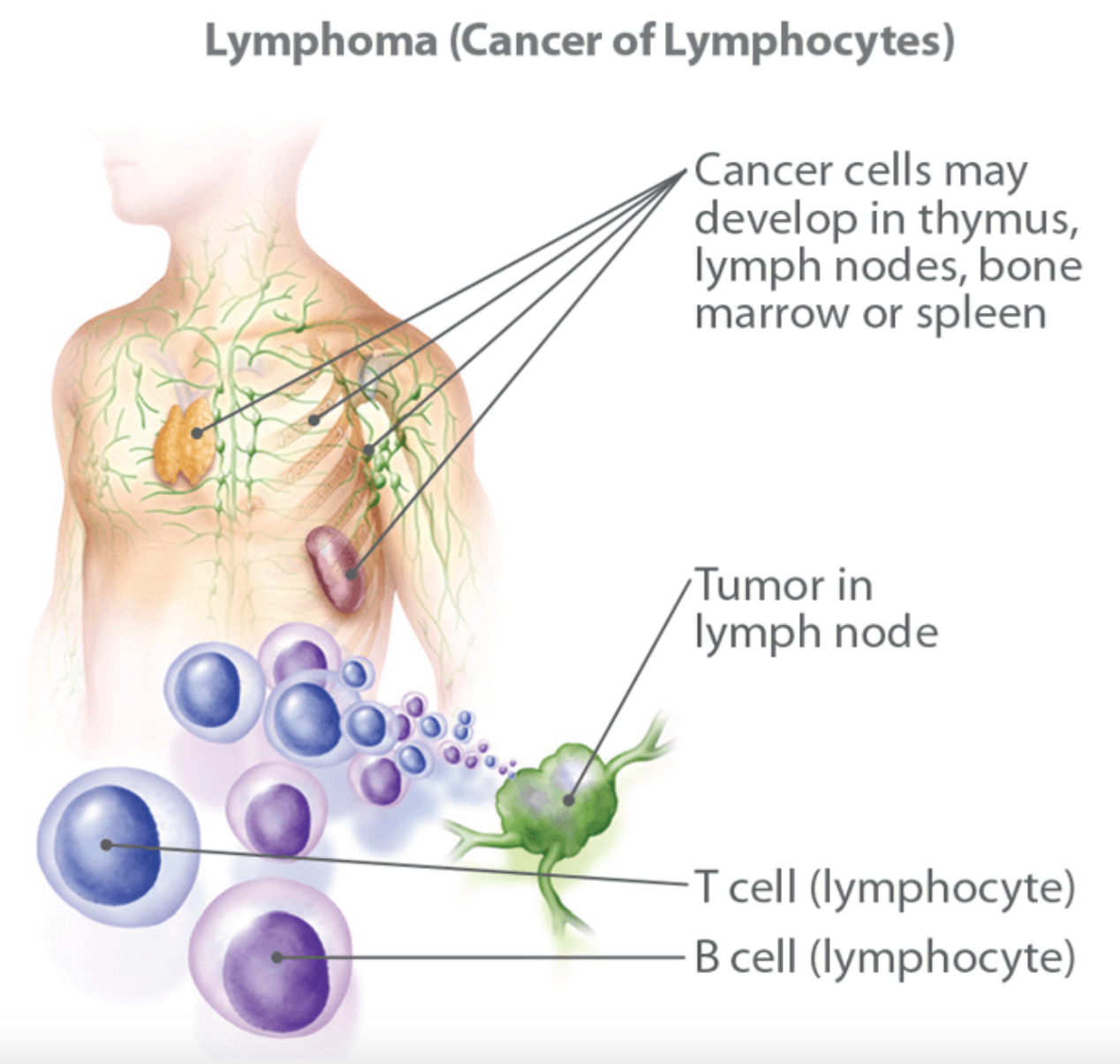 EBV causes several types of lymphomas--or cancers formed from white blood cells. Source: Cancercenter.com