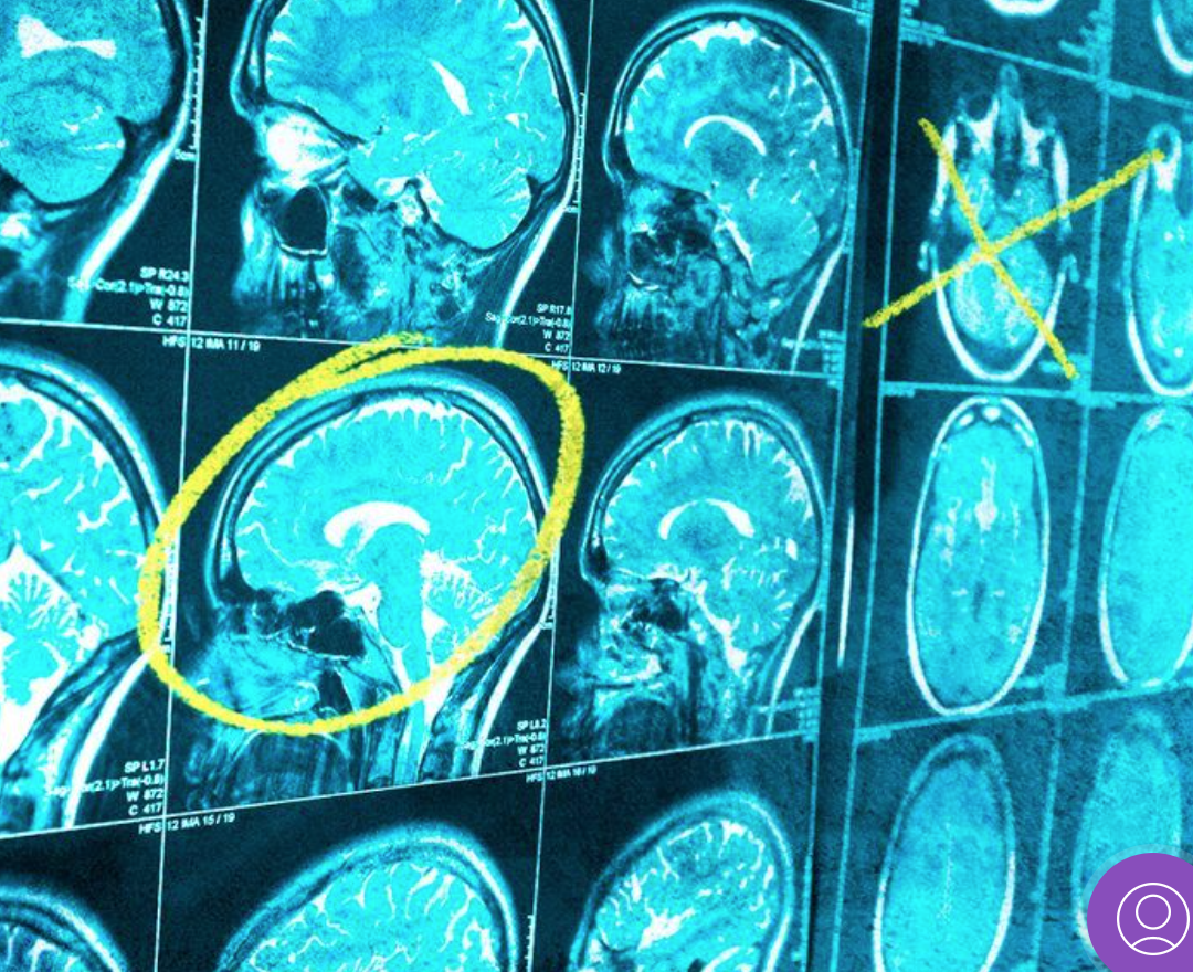 New discovery could be a step towards future immunotherapy for brain cancer