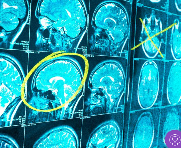 New discovery could be a step towards future immunotherapy for brain cancer