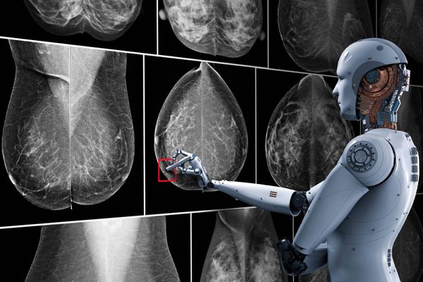 AI helps speed up breast cancer tracking but you can help too!