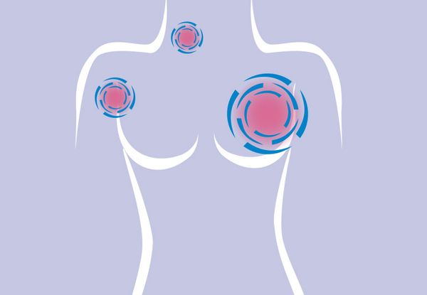 Warning system can flag up secondary tumor sites