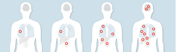 Cancer 101: Shapeshifting, invasion, and metastasis