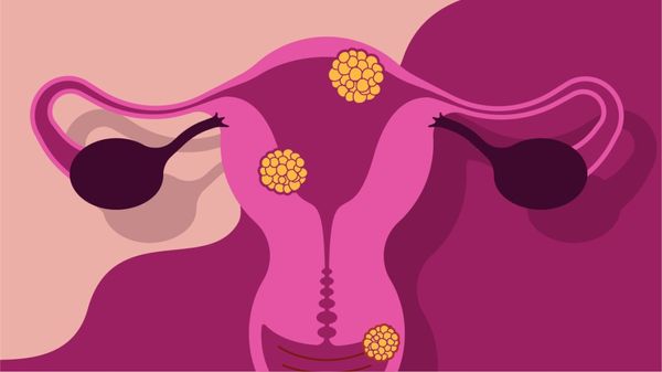 How do the 'wrong bacteria' in the vagina up the risk of preterm birth?