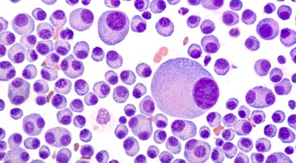 CAR-T Therapies Successfully Take On Multiple Myeloma